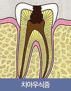 치아우식증