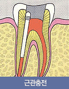 근관충전