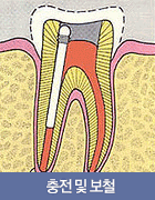 충전 및 보철
