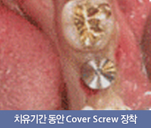 치유기간 동안 Cover Screw 장착