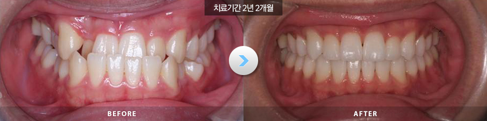 전후사진