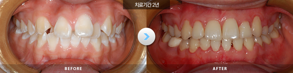 전후사진