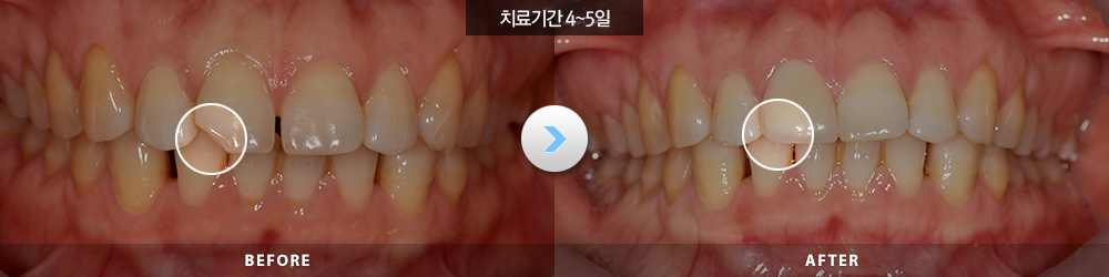 전후사진