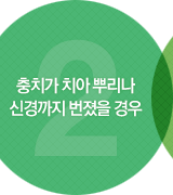 충치가 치아 뿌리나 신경까지 번졌을 경우