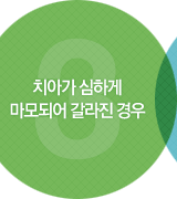 치아가 심하게 마모되어 갈라진 경우