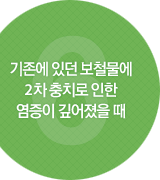 기존에 있던 보철물에 2차 충치로 인한 염증이 깊어졌을 때