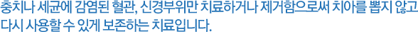 충치나 세균에 감염된 혈관, 신경부위만 치료하거나 제거함으로써 치아를 뽑지 않고 다시 사용할 수 있게 보존하는 치료입니다.