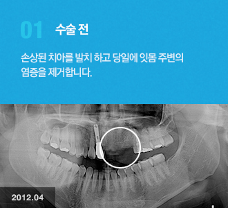 01.수술전