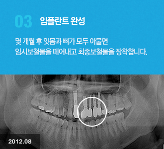 03.임플란트완성