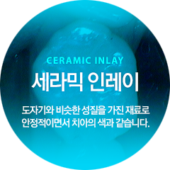 세라믹 인레이