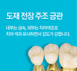 도재 전장 주조 금관